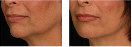 Raffermissement du visage par laser de rajeunissement